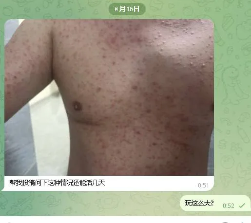 #群友投稿：前一个月在西港找了个按摩妹，想着便宜就去了。自己也有一段时间没碰女人了，一时兴起没戴套，结果最近身上开始陆陆续续长痘痘。